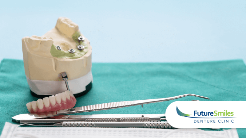 Future Smiles Denture Clinic | Blog | What Are Implant Supported Dentures?